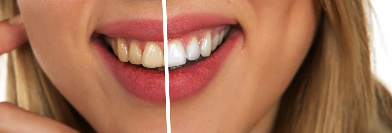 girl smiling face before and after deep teeth cleaning