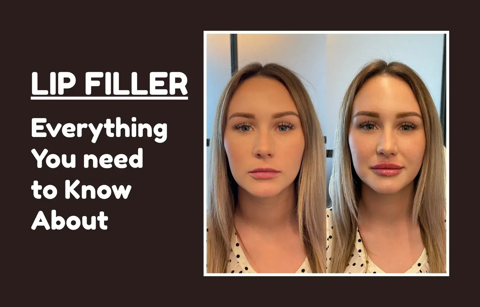 An image showing a Lady who used Lip Filler service
